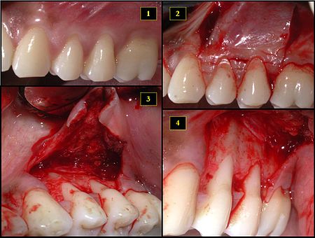 Gingival and Flap Surgeries