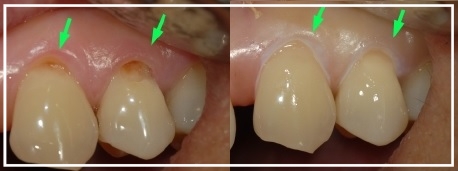 Tooth Coloured Filling