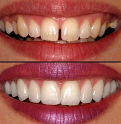 Cosmetic Smile Designing