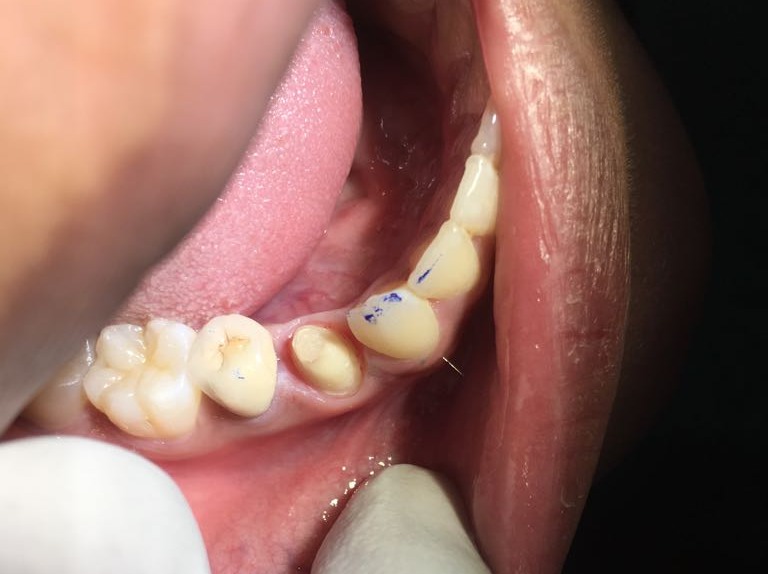 Tooth Repair and Replacement