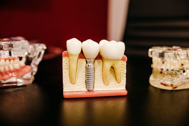 Dental Implants and Caps