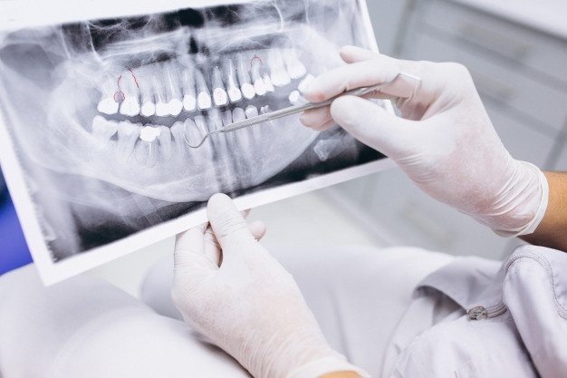 Dental X-Ray and Tooth Extraction