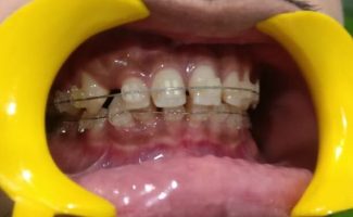 Orthodontic Tooth Correction