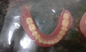 Complete and Partial Denture