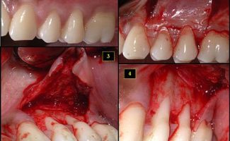 Gingival and Flap Surgeries