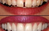 Cosmetic Smile Designing