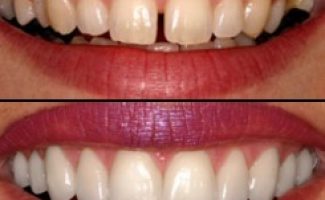 Cosmetic Smile Designing