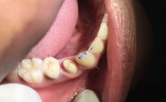 Tooth Repair and Replacement