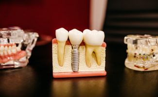 Dental Implants and Caps