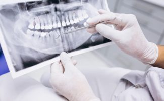 Dental X-Ray and Tooth Extraction